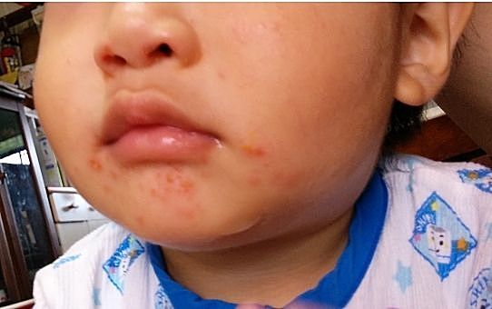 手足口病が2年ぶりに都の警報基準超えに！